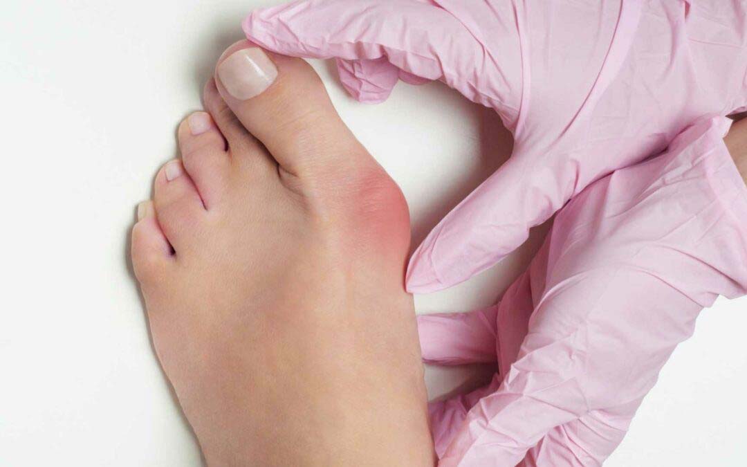 Bunions & Foot Problems - What is a Bunion