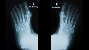 How bunions affect bone