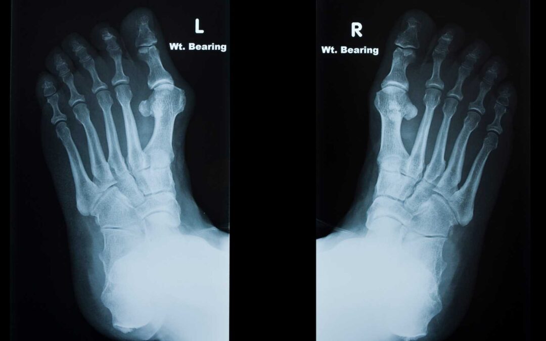 Blog-How-Bunions-Affect-Bone