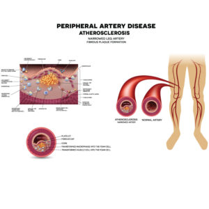 Peripheral Artery Disease – Podiatry Associates