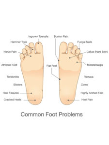Common Foot Issues Diagram