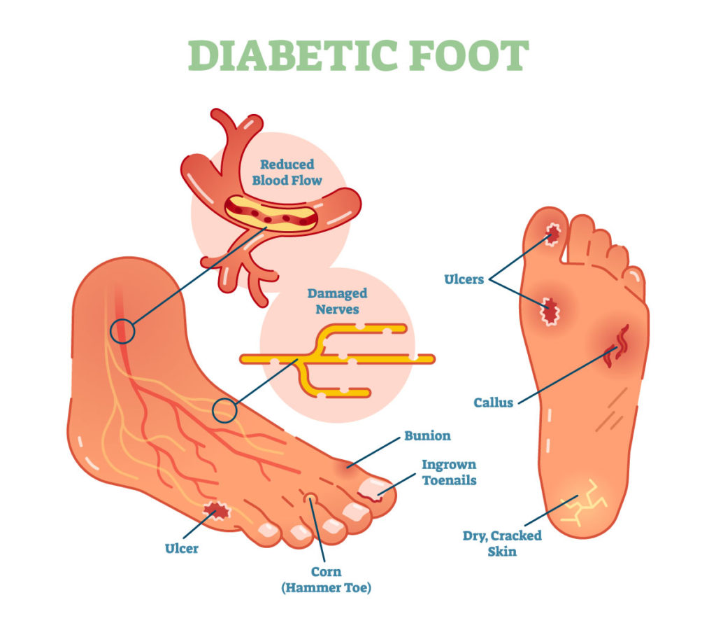 Diabetic Foot Management - MVS Podiatry Associates