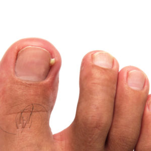 Ingrown Toenail