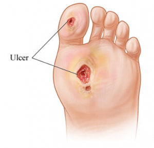 wound care treatment baltimore – Podiatry Associates