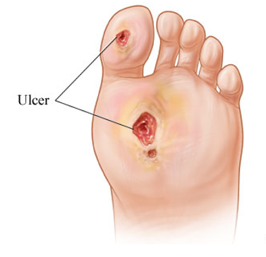 foot with diabetic ulcers - MVS Podiatry Associates