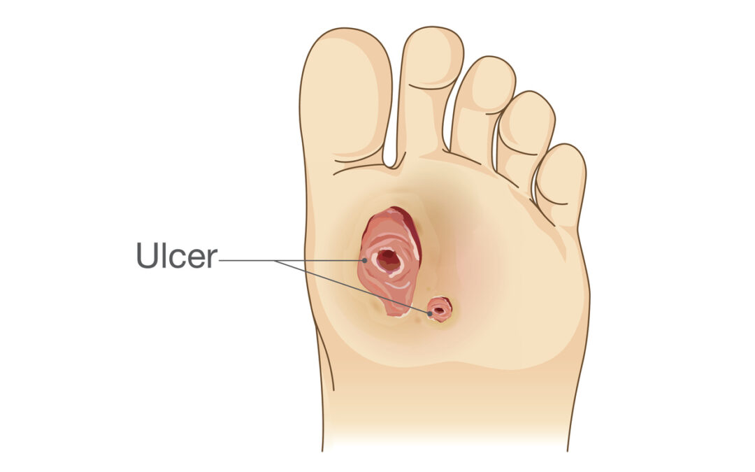 Diabetic Foot Pain and Ulcers.