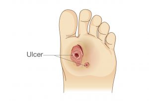 Wound Care Ulcer