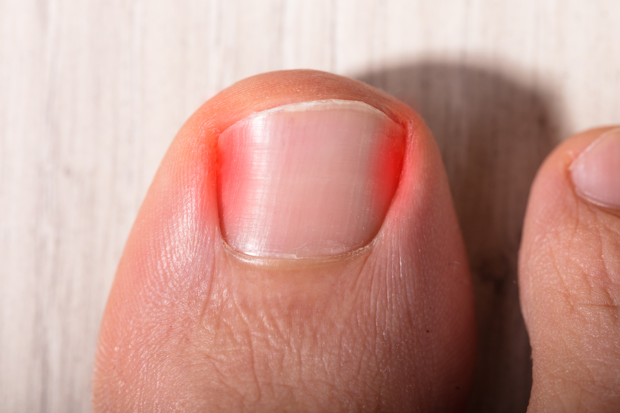 When Should You Go to the Doctor for an Ingrown Toenail? - MVS