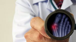 bunion surgery in baltimore