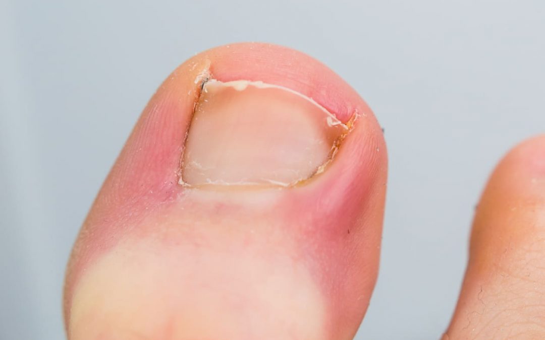 How To Treat An Infected Ingrown Toenail MVS Podiatry Associates