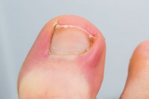 how to treat an infected ingrown toenail