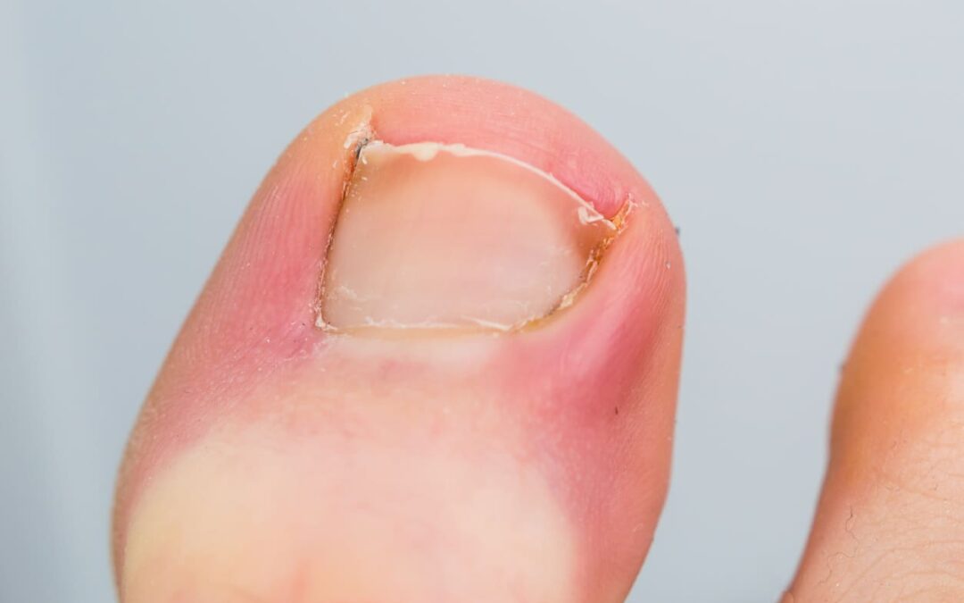 infected ingrown toenail