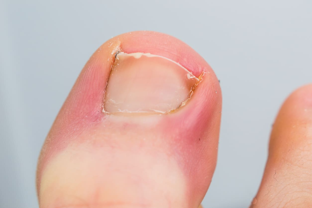 How To Clear Infected Ingrown Toenail