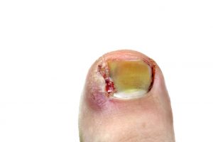 untreated ingrown toenail