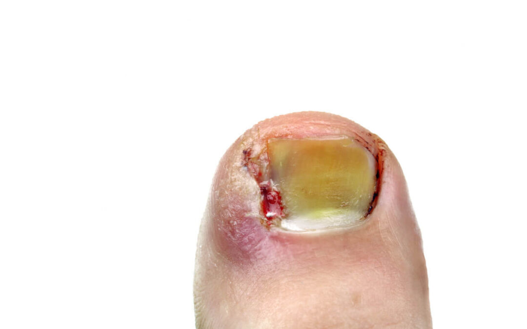 untreated ingrown toenail